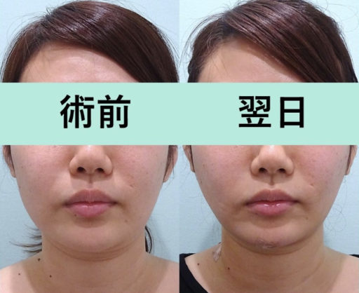 頬・顎下脂肪吸引 スレッドリフト
