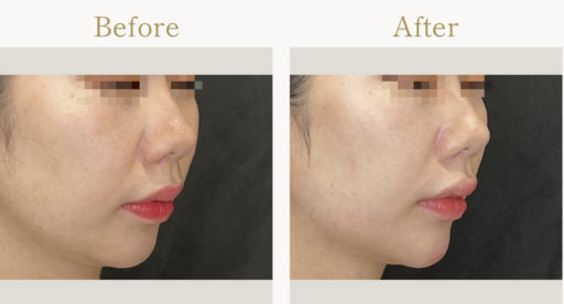 顎ヒアルロン酸