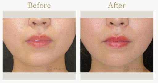 唇ヒアルロン酸 人中短縮ボトックス