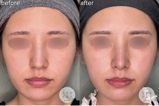 鼻尖形成 耳介軟骨移植