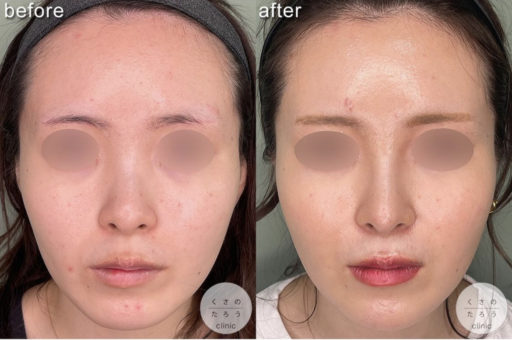 鼻中隔延長 シリコンプロテーゼ