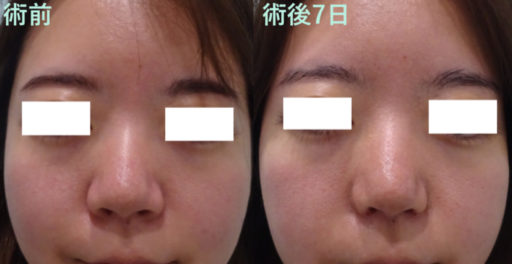 鼻尖形成 小鼻縮小