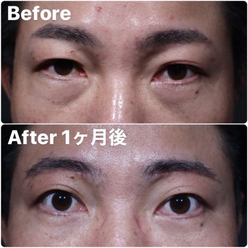 眉下切開 下眼瞼脱脂