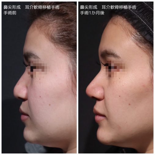 鼻尖形成 耳介軟骨移植