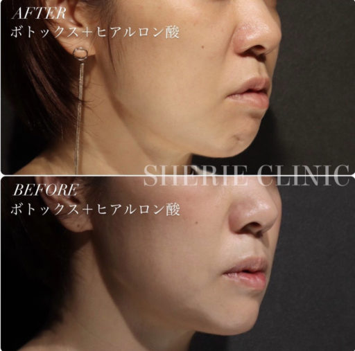 顎ボトックス 顎ヒアルロン酸