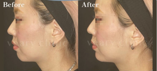 顎ヒアルロン酸