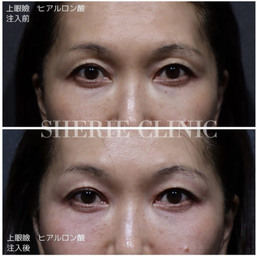 上瞼ヒアルロン酸