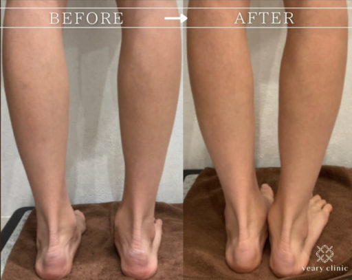 ふくらはぎボトックス