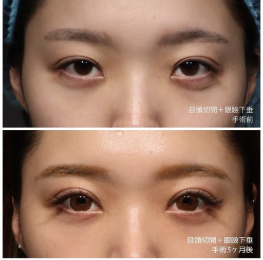 目頭切開 眼瞼下垂
