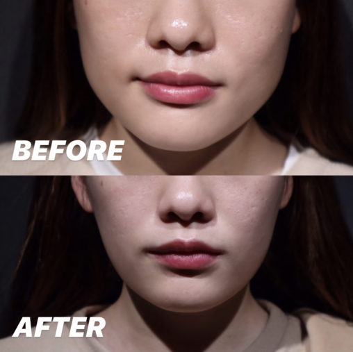 エラボトックス