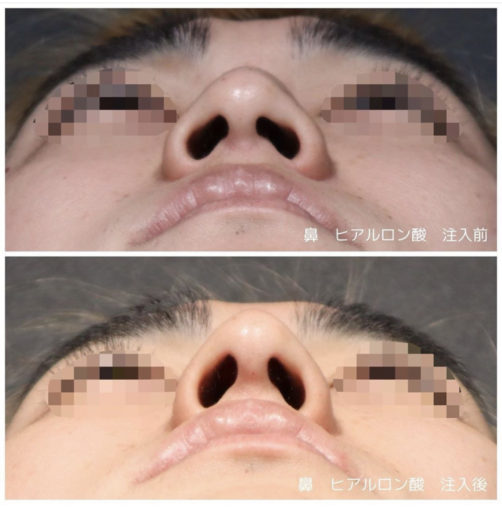 鼻ヒアルロン酸