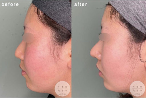 鼻尖形成 耳介軟骨移植