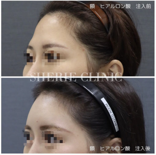 額ヒアルロン酸