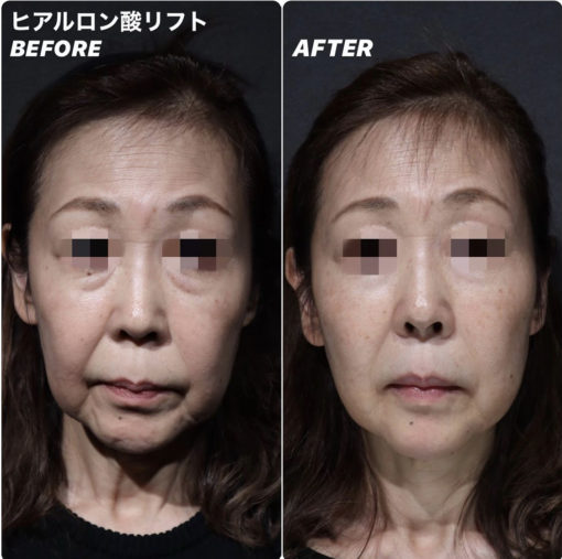 ヒアルロン酸リフト