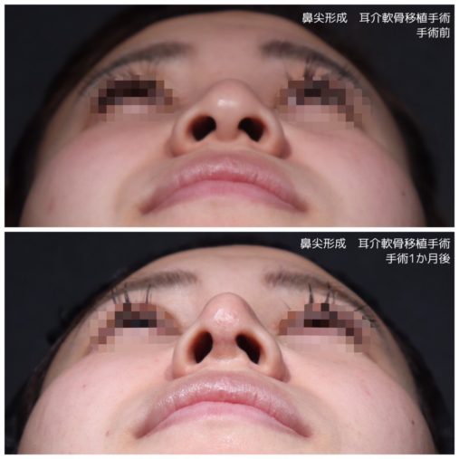 鼻尖形成 耳介軟骨移植
