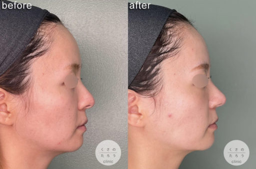 耳介軟骨移植 鼻孔縁下降