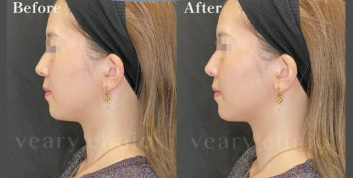 法令線ヒアルロン酸