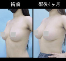 シリコン豊胸