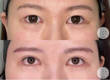 二重切開<br />
眉下切開