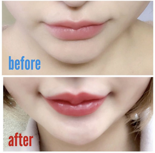 唇ヒアルロン酸