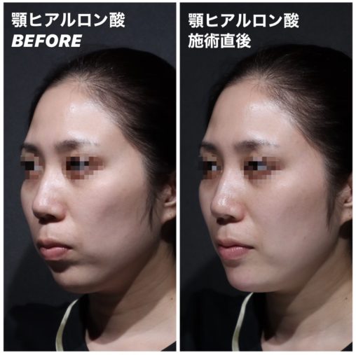 顎ヒアルロン酸
