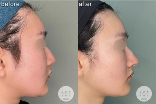 鼻翼縮小 耳介軟骨移植