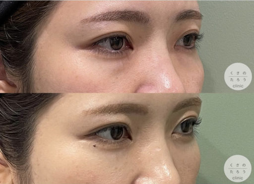 脱脂＋脂肪注入