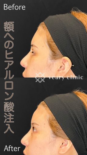 額ヒアルロン酸