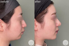 鼻尖形成<br />
耳介軟骨移植<br />
顎プロテーゼ