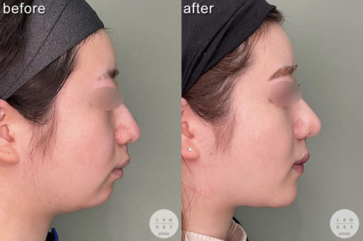 鼻尖形成 耳介軟骨移植 顎プロテーゼ