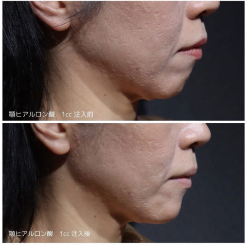 顎ヒアルロン酸