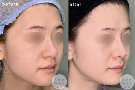 鼻中隔延長 鼻翼縮小 シリコンプロテーゼ