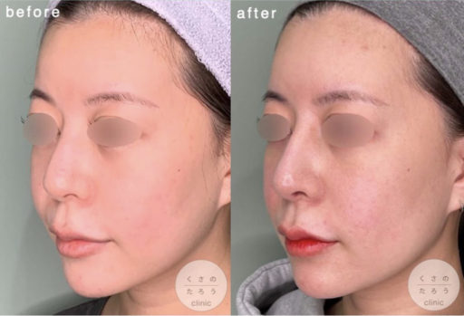 鼻中隔延長 プロテーゼ入れ替え