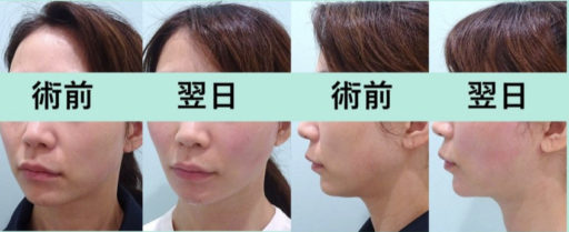 頬・顎下脂肪吸引 バッカルファット スレッドリフト エラ・顎ボトックス