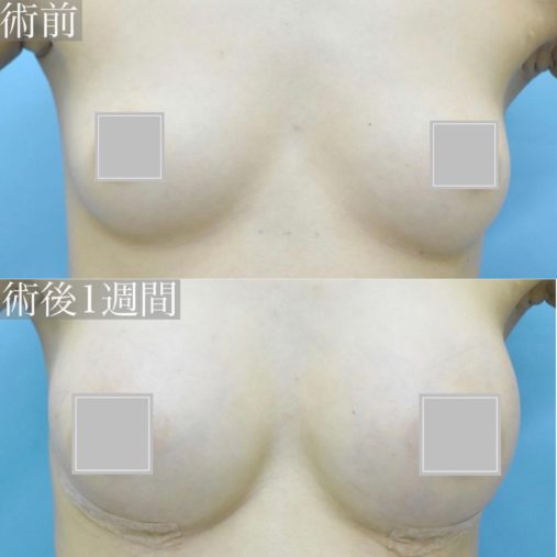シリコン豊胸
