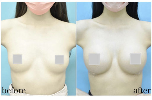 シリコン豊胸
