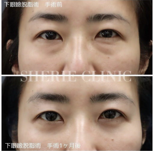 下眼瞼脱脂