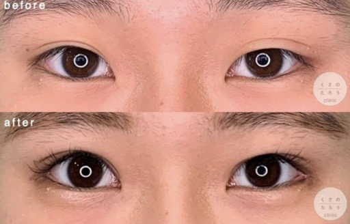 眼瞼下垂 目尻切開
