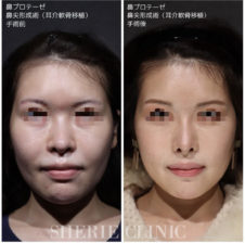 鼻プロテーゼ<br />
鼻尖形成