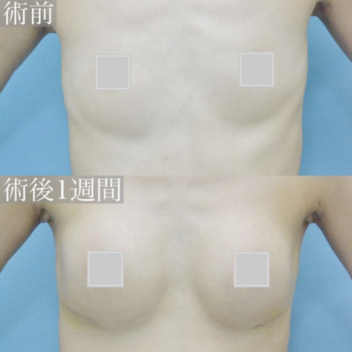 シリコン豊胸