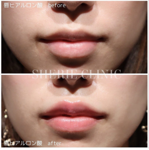 唇ヒアルロン酸