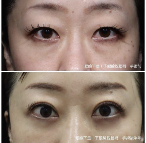 眼瞼下垂 下眼瞼脱脂
