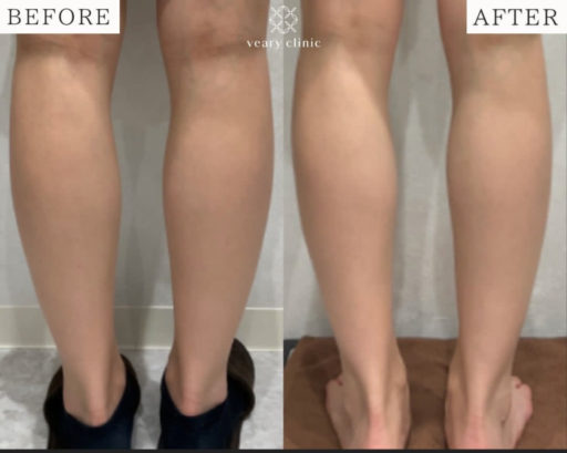 脚ボトックス 脂肪溶注射