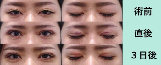 二重埋没 上瞼脱脂