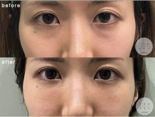 脱脂＋脂肪注入 ナノファットグラフト