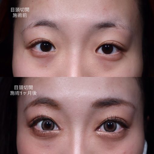 目頭切開