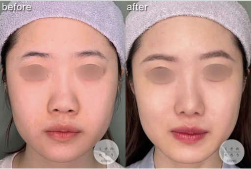 鼻尖形成 耳介軟骨移植 鼻翼縮小