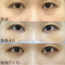 下眼瞼脂肪移動<br />
(裏ハムラ法)