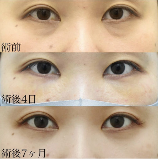 下眼瞼脂肪移動 (裏ハムラ法)
