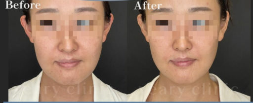 頬骨上・法令線ヒアルロン酸